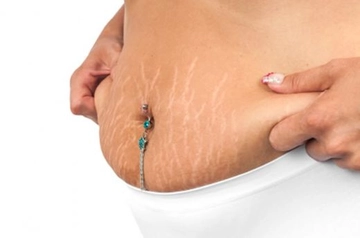 Gebelikte Çatlak Belirtileri ve Tedavisi