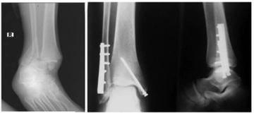 Kırık Ayak Bileği Belirtileri ve Tedavisi