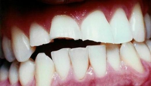 Kırık Diş Nasıl Çekilir