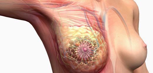 Meme Ucu Çatlağı Belirtileri ve Tedavisi